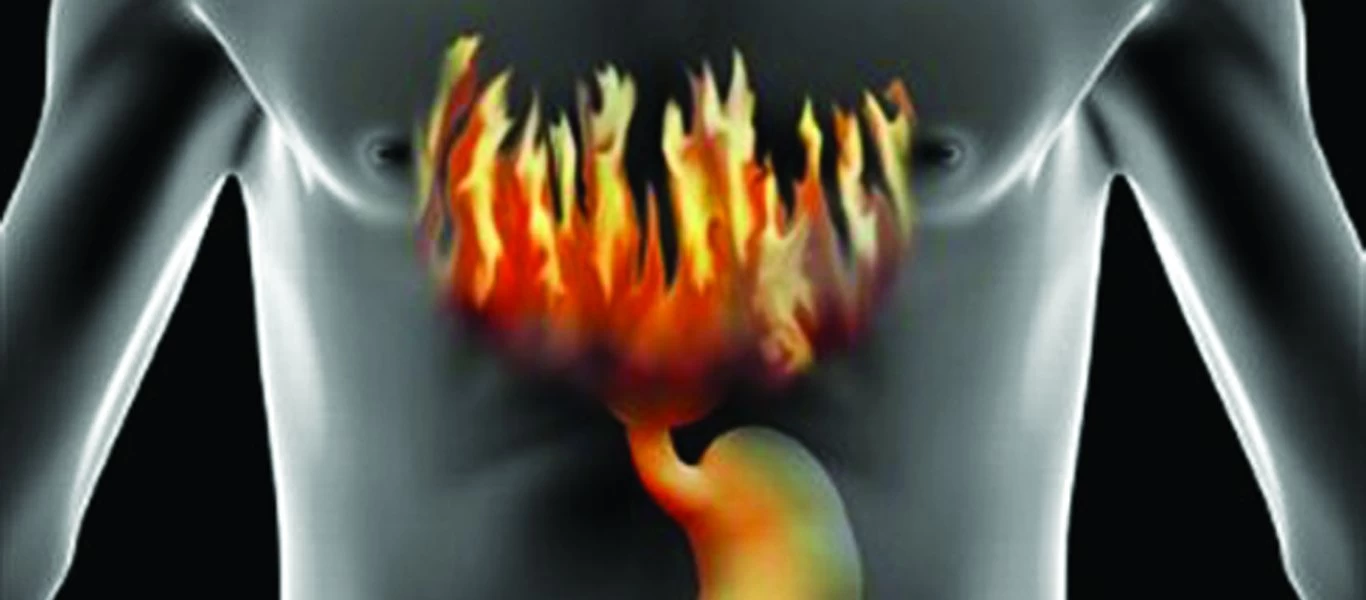 Οι τροφές που ευθύνονται για την γαστροοισοφαγική παλινδρόμηση - Τα συμπτώματα